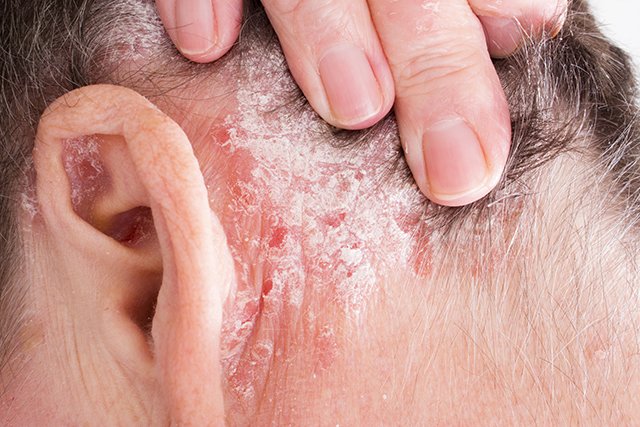 Psoriasis linked to gut health: Leaky gut could be caused by microbiome composition