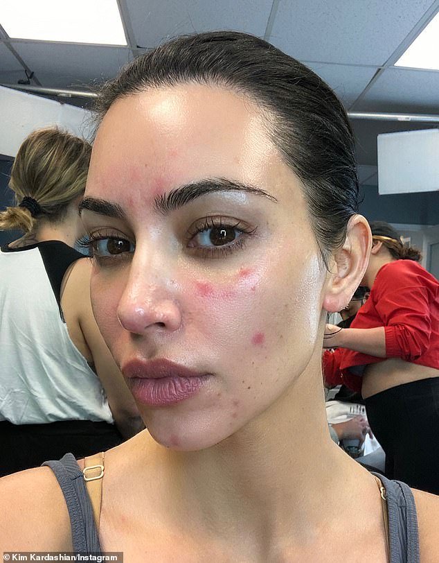 The psoriasis explosion – and how to cure it WITHOUT drugs: As cases soar, how so many go on to develop devastating conditions and doctors misdiagnose them. Now ETHAN ENNELS talks to world-renowned experts and reveals the answers